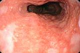 Barrett's oesophagus, a possible complication of reflux symptoms (Photograph: SPL)