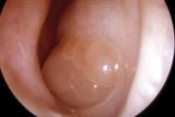 Nasal polyp: oral steroid treatment reduced their size (Photograph: SPL)