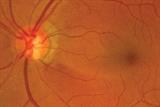 Retinal nerve fibre defect