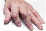 Delays: the rheumatoid factor test may miss cases of arthritis (Photo: SPL)