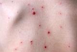 Chickenpox