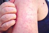 Measles rash on upper arm