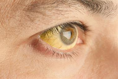 Jaundice eye