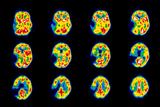 Stroke: coloured PET scan of a stroke patient's brain (Photo: Science Photo Library)