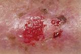 Ulcer location: clue to aetiology (Photograph: SPL)