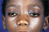 Patient with signs of upper eyelid and facial weakness (Photograph: SPL)